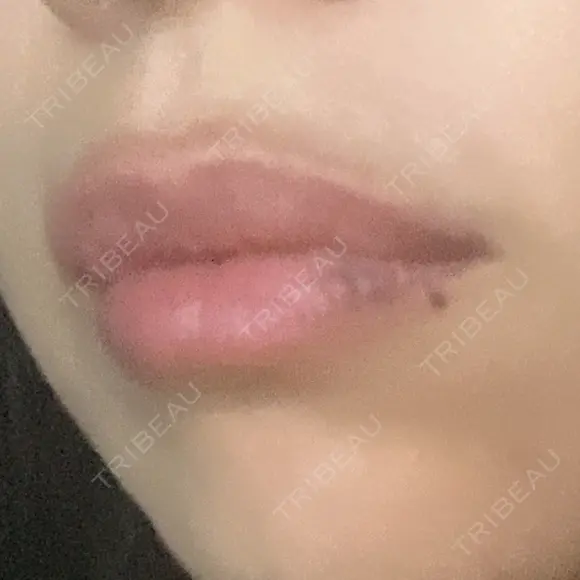 ヒアルロン酸注入（唇） アネシス美容クリニック DAY 4 メイン用