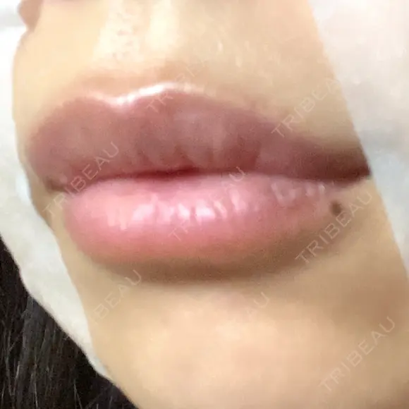 ヒアルロン酸注入（唇） アネシス美容クリニック DAY 5 メイン用