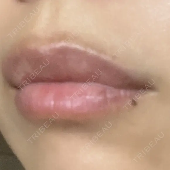 ヒアルロン酸注入（唇） アネシス美容クリニック DAY 6 メイン用