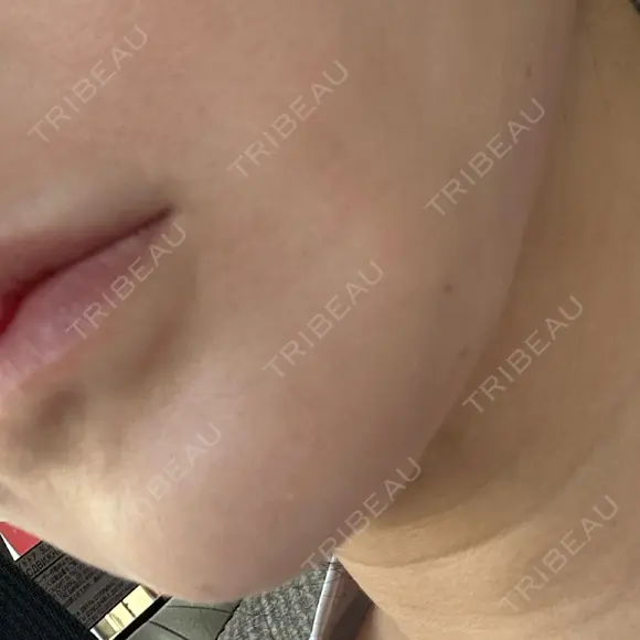 糸リフト / ボトックス（あご） / ヒアルロン酸注入（あご） / RF（高周波）たるみ治療 / ピーリング（ハリ・ツヤ） ルラ美容クリニック 千葉院 / ルラスキンクリニック 千葉院 AFTER メイン用