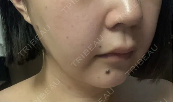 ヒアルロン酸注入（唇） / ヒアルロン酸注入（頬） Wi Clinic （ウィ クリニック）心斎橋院 AFTER メイン用