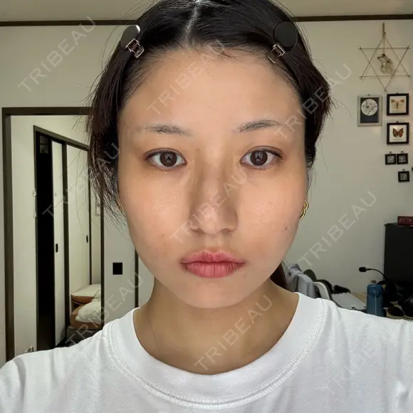 ボトックス（エラ・小顔） / ボトックス（肩） DMTC美容皮膚科 大宮院 DAY 0 メイン用