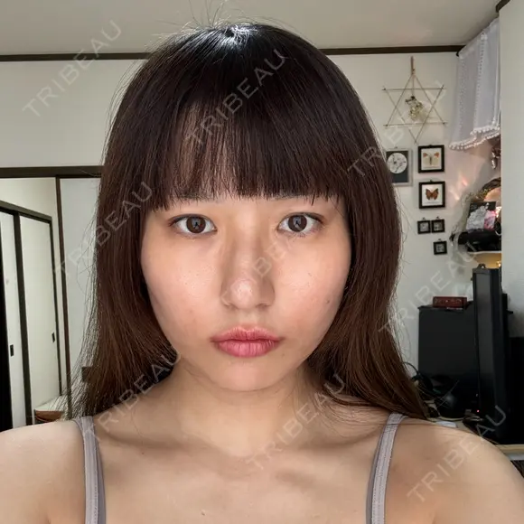 ボトックス（エラ・小顔） / ボトックス（肩） DMTC美容皮膚科 大宮院 DAY 0 メイン用