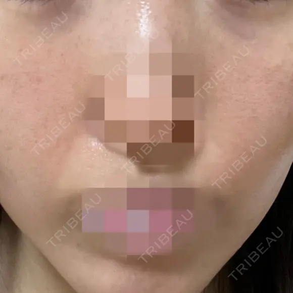 ポテンツァ ルラ美容クリニック 岡山院 DAY 3 メイン用