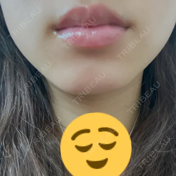 ボトックス（エラ・小顔） TCB東京中央美容外科 天王寺院 AFTER メイン用