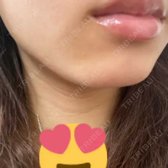 ボトックス（エラ・小顔） TCB東京中央美容外科 天王寺院 DAY 11 メイン用