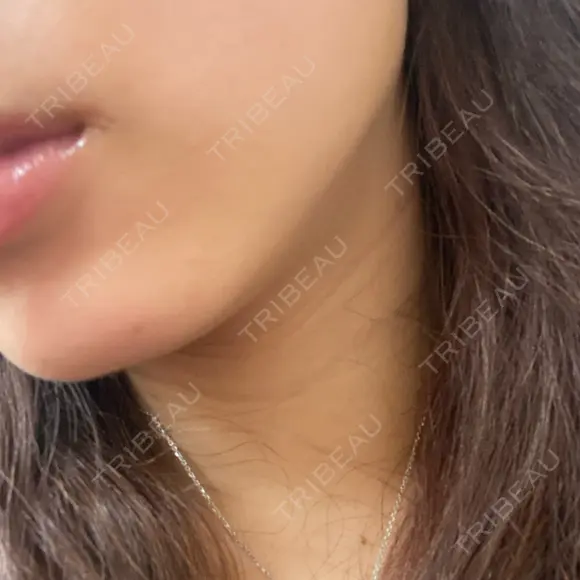 ボトックス（エラ・小顔） TCB東京中央美容外科 天王寺院 DAY 11 メイン用