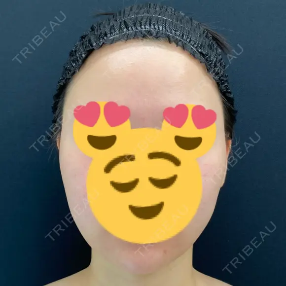 医療脱毛（顔） / ルメッカ 栄美容クリニック 栄院 AFTER メイン用
