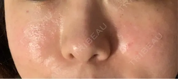 肌育注射（ジュベルックなど） / その他（肌） 新宿Ladies&Gentlemen美容クリニック DAY 0 メイン用