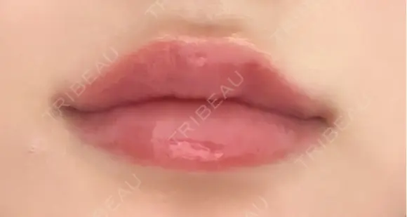 ヒアルロン酸注入（唇） Wing clinic 豊中駅前院 DAY 7 メイン用