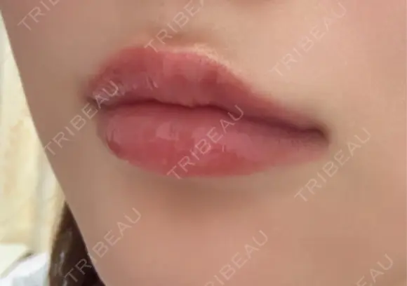 ヒアルロン酸注入（唇） Wing clinic 豊中駅前院 DAY 7 メイン用