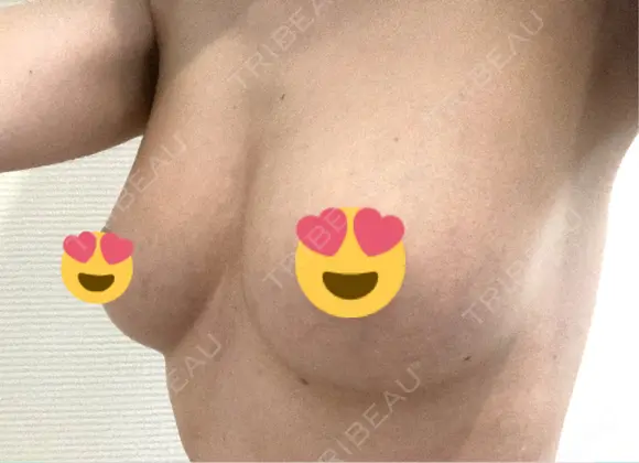豊胸（脂肪注入） 湘南美容クリニック 高田馬場院 DAY 93 メイン用