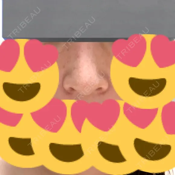 小鼻縮小（切開） アネシス美容クリニック AFTER メイン用