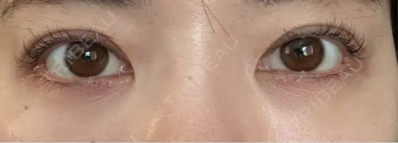 クマ治療 / 下まぶたたるみ取り / 下まぶたの脂肪取り / 脂肪注入（目の下） / ボトックス（あご） / ボトックス（眉間） お茶の水美容形成クリニック AFTER メイン用