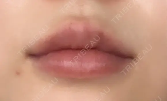 ヒアルロン酸注入（唇） Wing clinic 豊中駅前院 DAY 9 メイン用