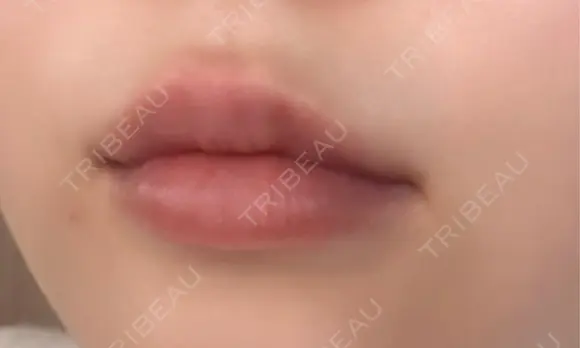 ヒアルロン酸注入（唇） Wing clinic 豊中駅前院 DAY 9 メイン用