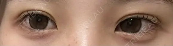 二重埋没 アーティスクリニック 博多 AFTER メイン用