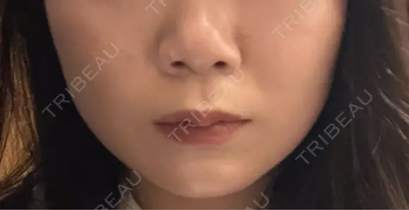ボトックス（あご） / ボトックス（ガミースマイル） / サーマジェン Wi Clinic （ウィ クリニック）心斎橋院 DAY 1 メイン用