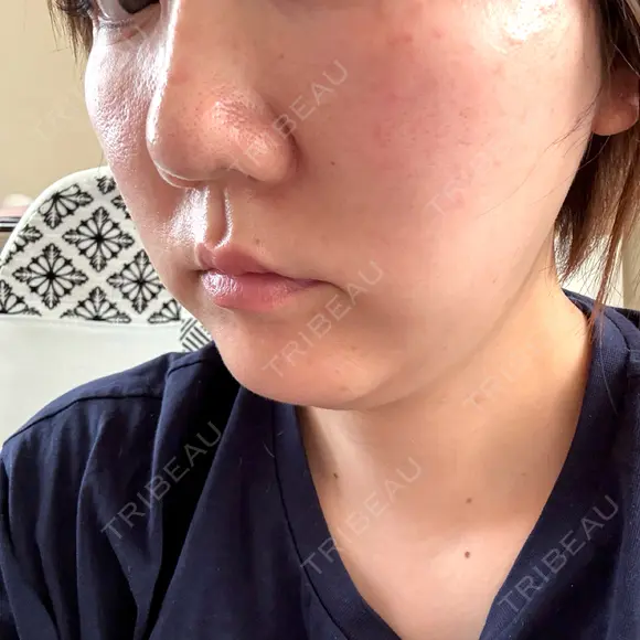 肌育注射（ジュベルックなど） 城本クリニック 岡山院 DAY 1 メイン用