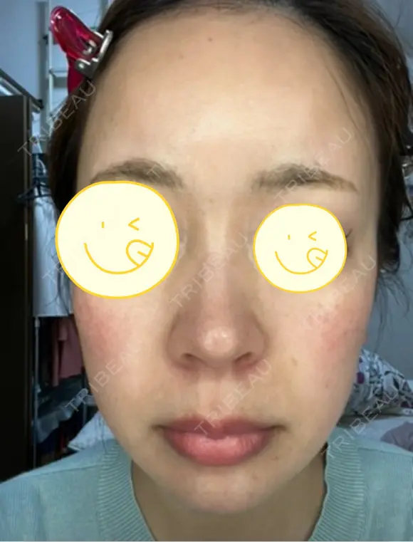 光治療（フォトフェイシャルなど） RAISE CLINIC 【レイズクリニック】 DAY 331 メイン用