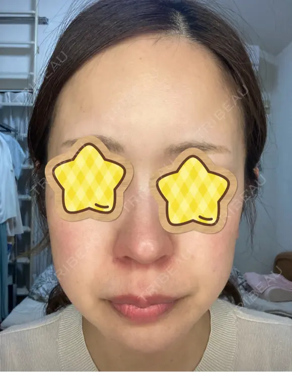 光治療（フォトフェイシャルなど） RAISE CLINIC 【レイズクリニック】 DAY 0 メイン用