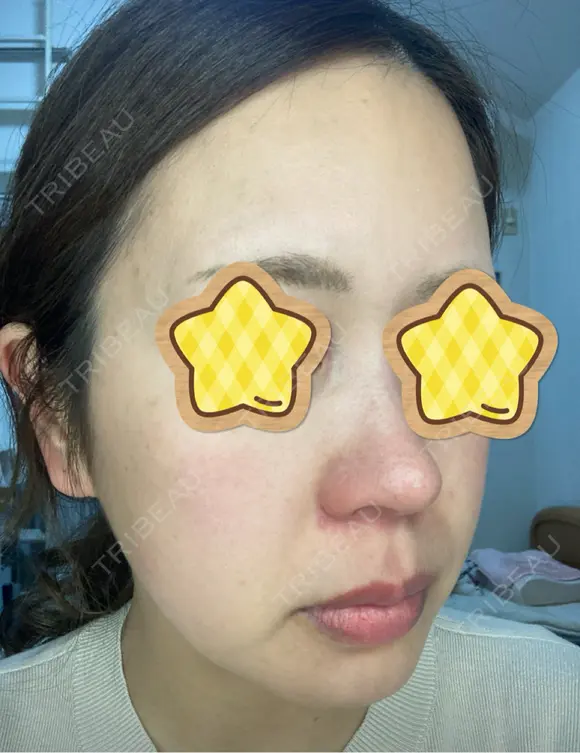 光治療（フォトフェイシャルなど） RAISE CLINIC 【レイズクリニック】 DAY 0 メイン用