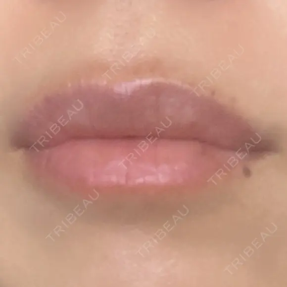 ヒアルロン酸注入（唇） アネシス美容クリニック DAY 7 メイン用