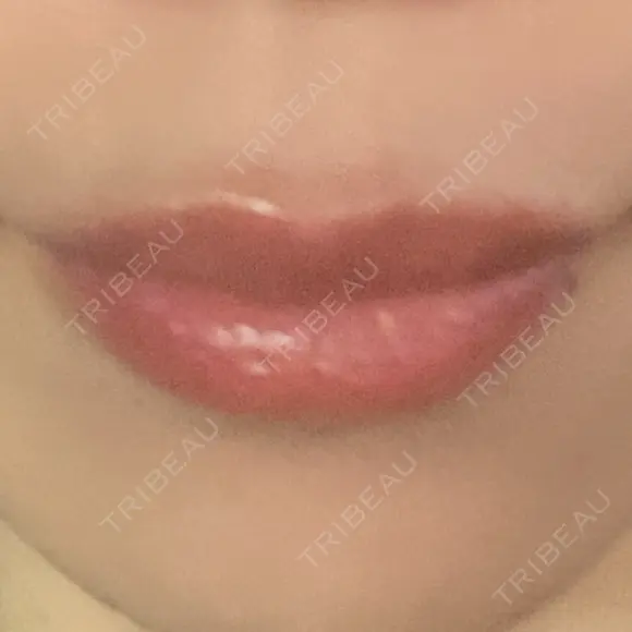 ヒアルロン酸注入（唇） アネシス美容クリニック DAY 8 メイン用