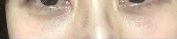 クマ治療 / 下まぶたたるみ取り 二子玉川美容外科クリニック DAY 14 メイン用