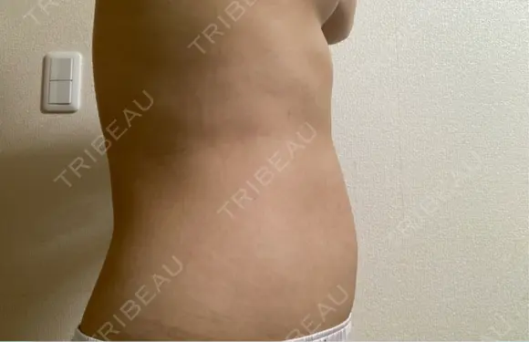 脂肪溶解注射（お腹） Nクリニック伏見 DAY 0 メイン用