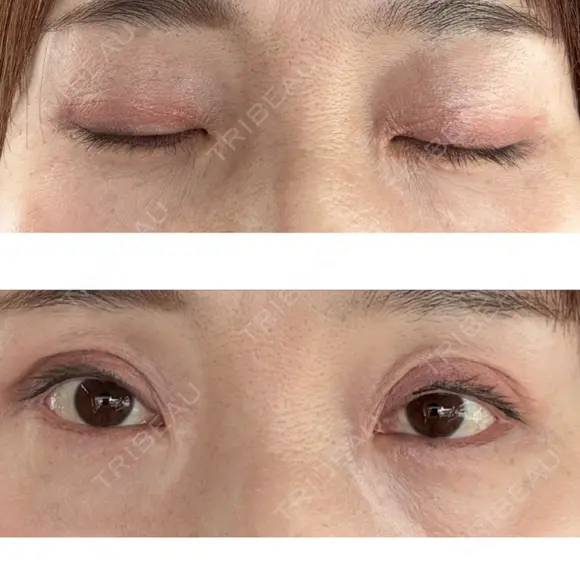 二重切開 / 眼瞼下垂（切開） オーキッド美容クリニック東京御徒町 AFTER メイン用