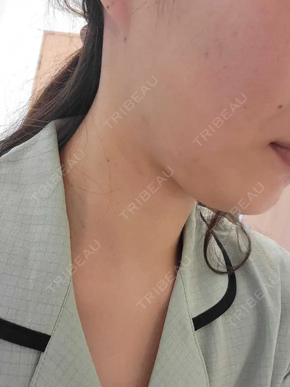 脂肪吸引（顔） アムルーズ美容外科クリニック 横浜院 DAY 36 メイン用