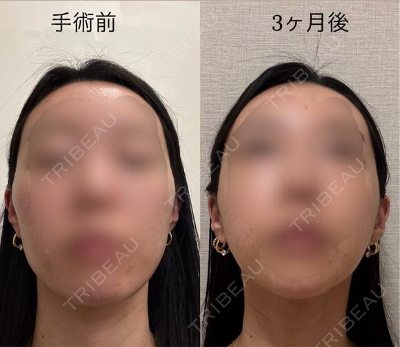 骨切り（あご） / 骨削り（エラ） / 骨削り（頬） セギム美容整形外科 AFTER メイン用
