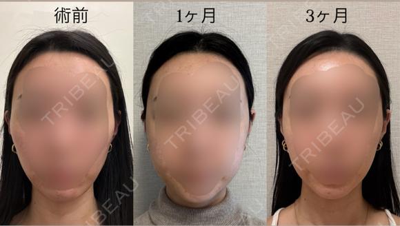骨切り（あご） / 骨削り（エラ） / 骨削り（頬） セギム美容整形外科 DAY 92 メイン用