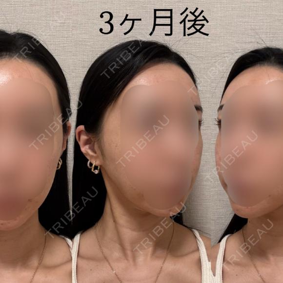 骨切り（あご） / 骨削り（エラ） / 骨削り（頬） セギム美容整形外科 DAY 92 メイン用