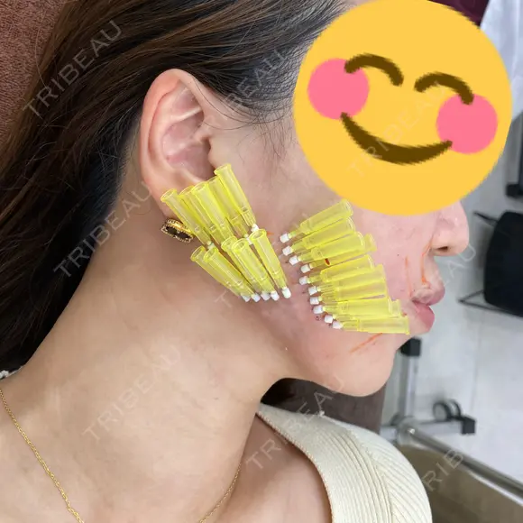 ショッピングリフト APスキンクリニック銀座 DAY 0 メイン用