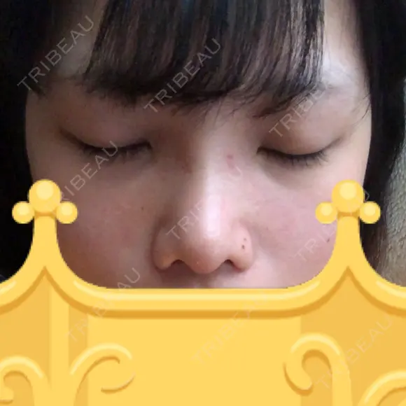 鼻尖形成（切開） / 小鼻縮小（切開） / 軟骨移植 / 眉間プロテーゼ 湘南美容クリニック 熊本院 DAY 10 メイン用