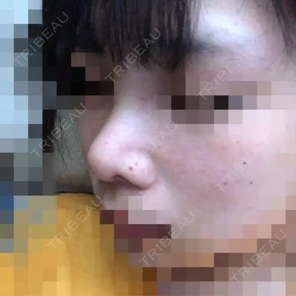 鼻尖形成（切開） / 小鼻縮小（切開） / 軟骨移植 / 眉間プロテーゼ 湘南美容クリニック 熊本院 DAY 10 メイン用