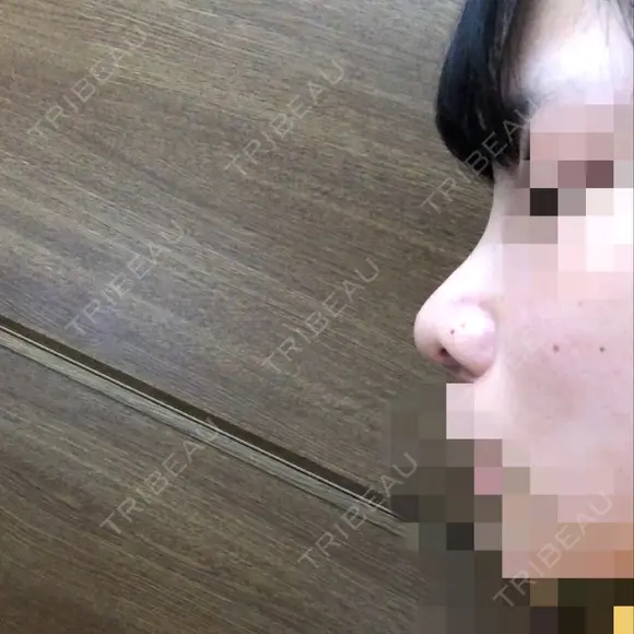 鼻尖形成（切開） / 小鼻縮小（切開） / 軟骨移植 / 眉間プロテーゼ 湘南美容クリニック 熊本院 DAY 10 メイン用