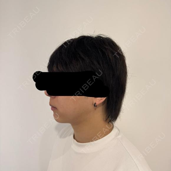 糸リフト / 脂肪吸引（顔） / 脂肪吸引注射（顔） / ヒアルロン酸注入（あご） SEA CLINIC（シークリニック） DAY 63 メイン用