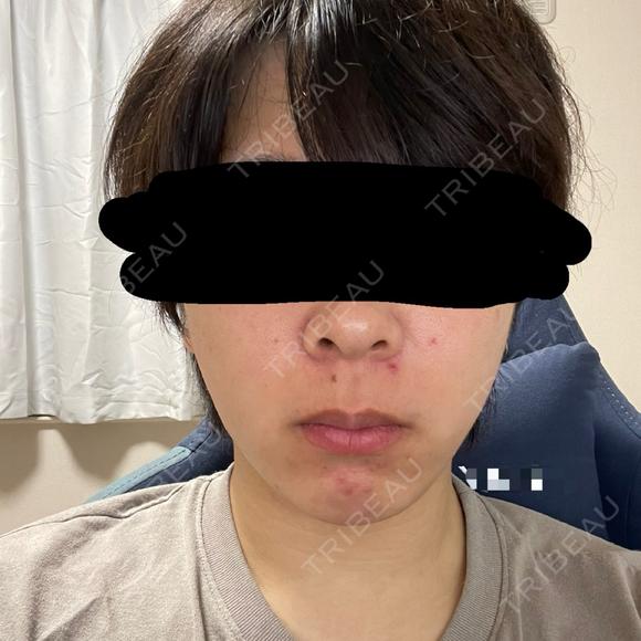 糸リフト / 脂肪吸引（顔） / 脂肪吸引注射（顔） / ヒアルロン酸注入（あご） SEA CLINIC（シークリニック） DAY 122 メイン用