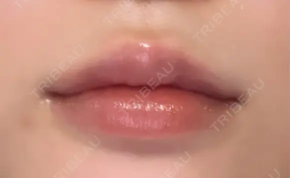 ヒアルロン酸注入（唇） Wing clinic 豊中駅前院 DAY 10 メイン用