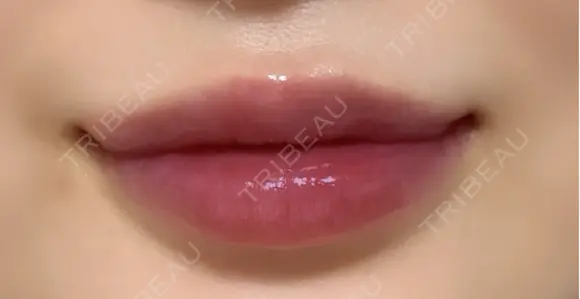 ヒアルロン酸注入（唇） Wing clinic 豊中駅前院 AFTER メイン用