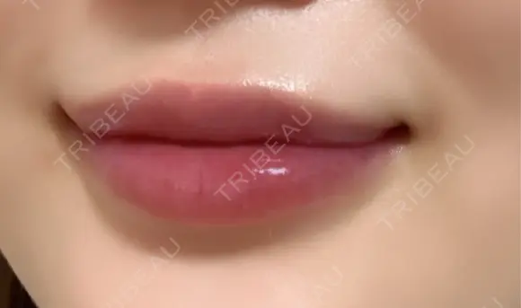 ヒアルロン酸注入（唇） Wing clinic 豊中駅前院 DAY 12 メイン用