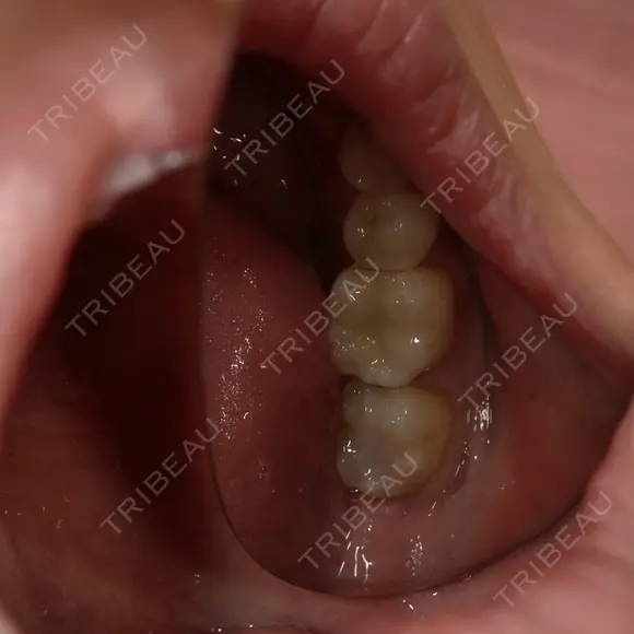 セラミック / その他（審美歯科/矯正歯科） 東京美容外科 赤坂院 DAY 17 メイン用