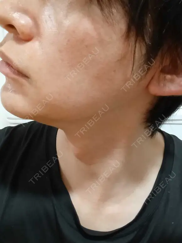 ルメッカ ルラ美容クリニック 名古屋本院 DAY 9 メイン用