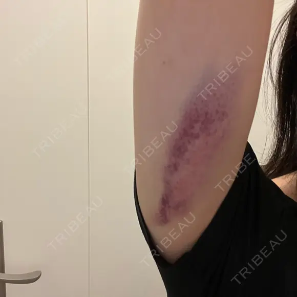 脂肪溶解注射（二の腕） ルラ美容クリニック 大阪心斎橋院 DAY 1 メイン用