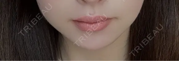 ボトックス（あご） / ヒアルロン酸注入（あご） / ボトックス（エラ・小顔） TCB東京中央美容外科 京都駅前院 AFTER メイン用