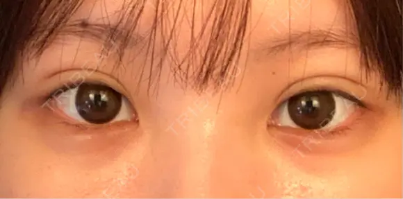 二重埋没 湘南美容クリニック 池袋東口院 DAY 7 メイン用