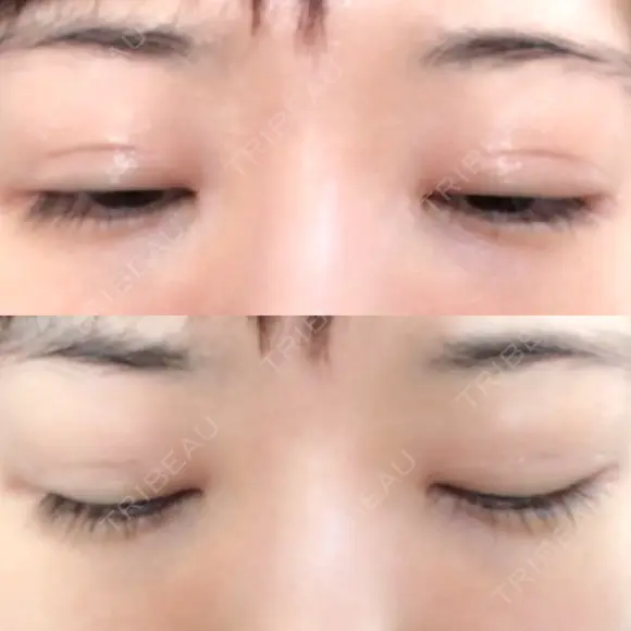 二重切開 / 目元修正 ルネッサンス美容外科医院 神戸院 DAY 140 メイン用